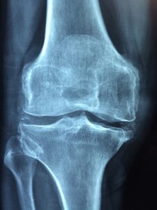 Knee joint X-ray showing osteoporosis leading to knee pain